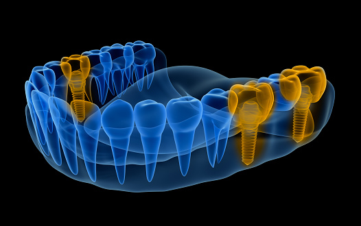 computer image of multiple tooth implants from Riverwind Dental in Richmond, VA