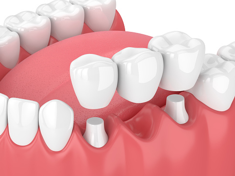 Computer rendering of a complete fixed bridge from Riverwind Dental in Richmond, VA