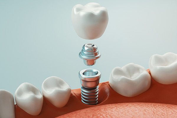computer rendering of a mouth with a single tooth implant from Riverwind Dental in Richmond, VA