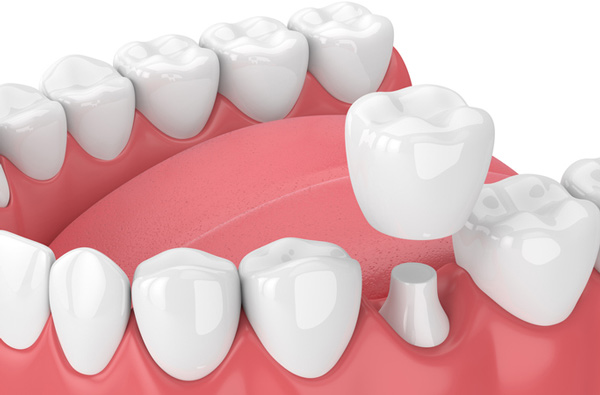 Rendering of jaw with dental crown from Riverwind Dental in Richmond, VA Rendering of jaw with dental crown from Riverwind Dental in Richmond, VA