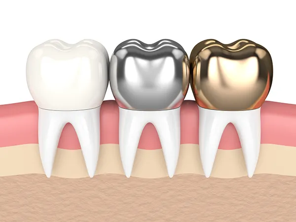 3D rendered cross-section view of three teeth with dental crowns made of different materials at Riverwind Dental in Richmond, VA
