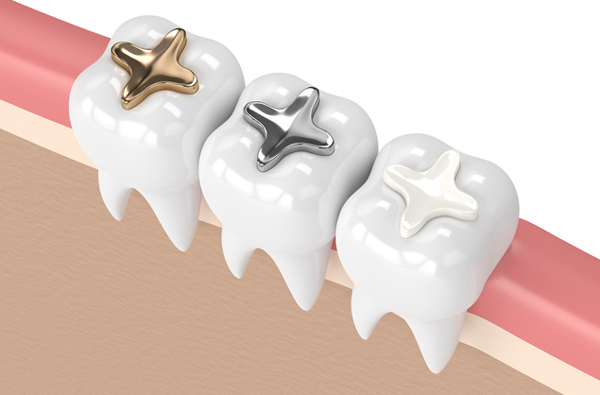 Rendering of teeth with 3 filling materials from Riverwind Dental in Richmond, VA