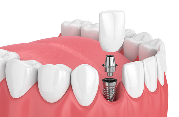 Rendering of jaw with dental implant from Riverwind Dental in Richmond, VA