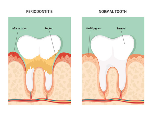 Diagram of a healthy tooth and one in need of periodontal care at Riverwind Dental in Richmond, VA