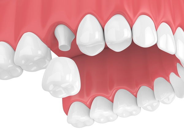 Rendering of jaw with porcelain dental crown from Riverwind Dental in Richmond, VA