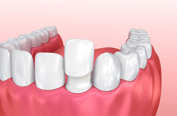 Rendering of jaw with porcelain veneer on tooth at Riverwind Dental in Richmond, VA