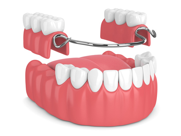 Rendering of removable partial denture from Riverwind Dental in Richmond, VA