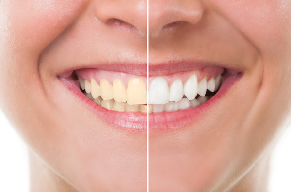 Before and after photo of teeth whitening treatment from Riverwind Dental in Richmond, VA