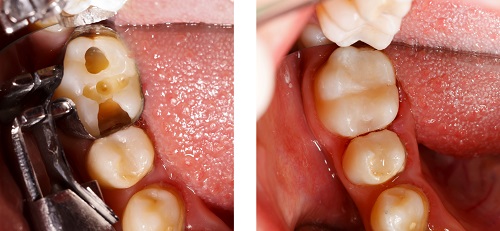 Photo of dental fillings from Riverwind Dental in Richmond, VA