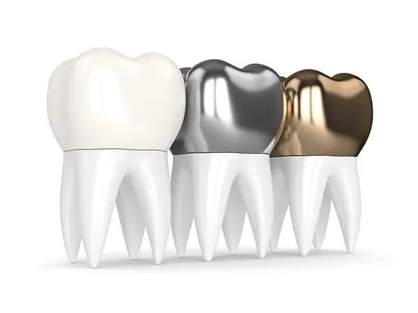 A display of ceramic, metal, and gold dental crowns on tooth models, highlighting the variety of materials for dental procedures.