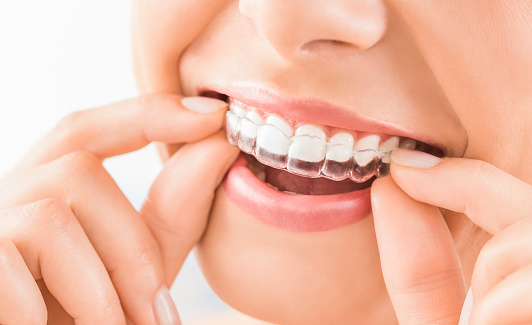 nightguards in Richmond, VA at Riverwind Dental 
