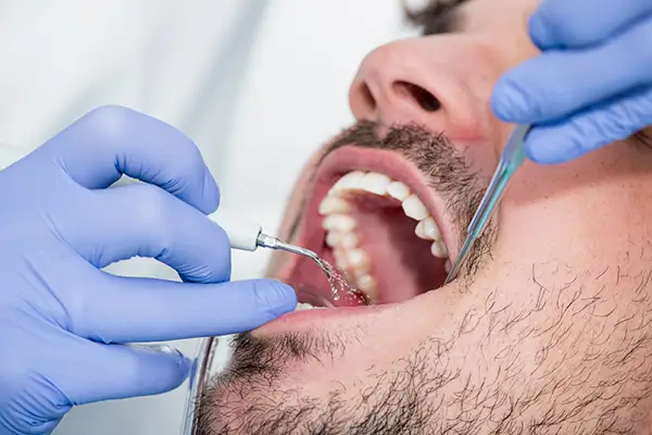 Dentist performing a periodontal cleaning procedure on a male patient at Riverwind Dental in Henrico, VA