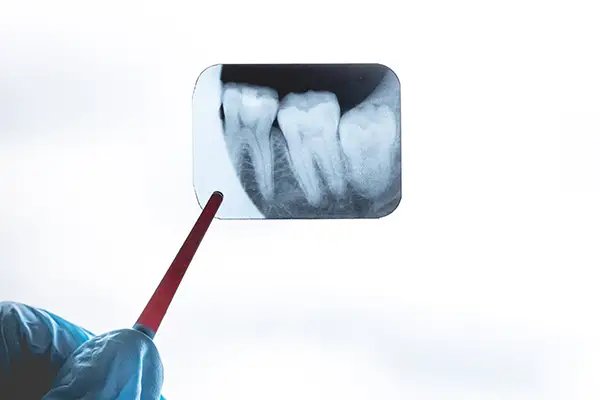 A dental X-ray image pointing to an impacted wisdom tooth pressing against neighboring teeth at Riverwind Dental in Henrico, VA